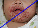 単純ヘルペスウイルス感染症の写真