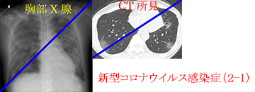 新型コロナウイルス胸部X線とCT所見の写真